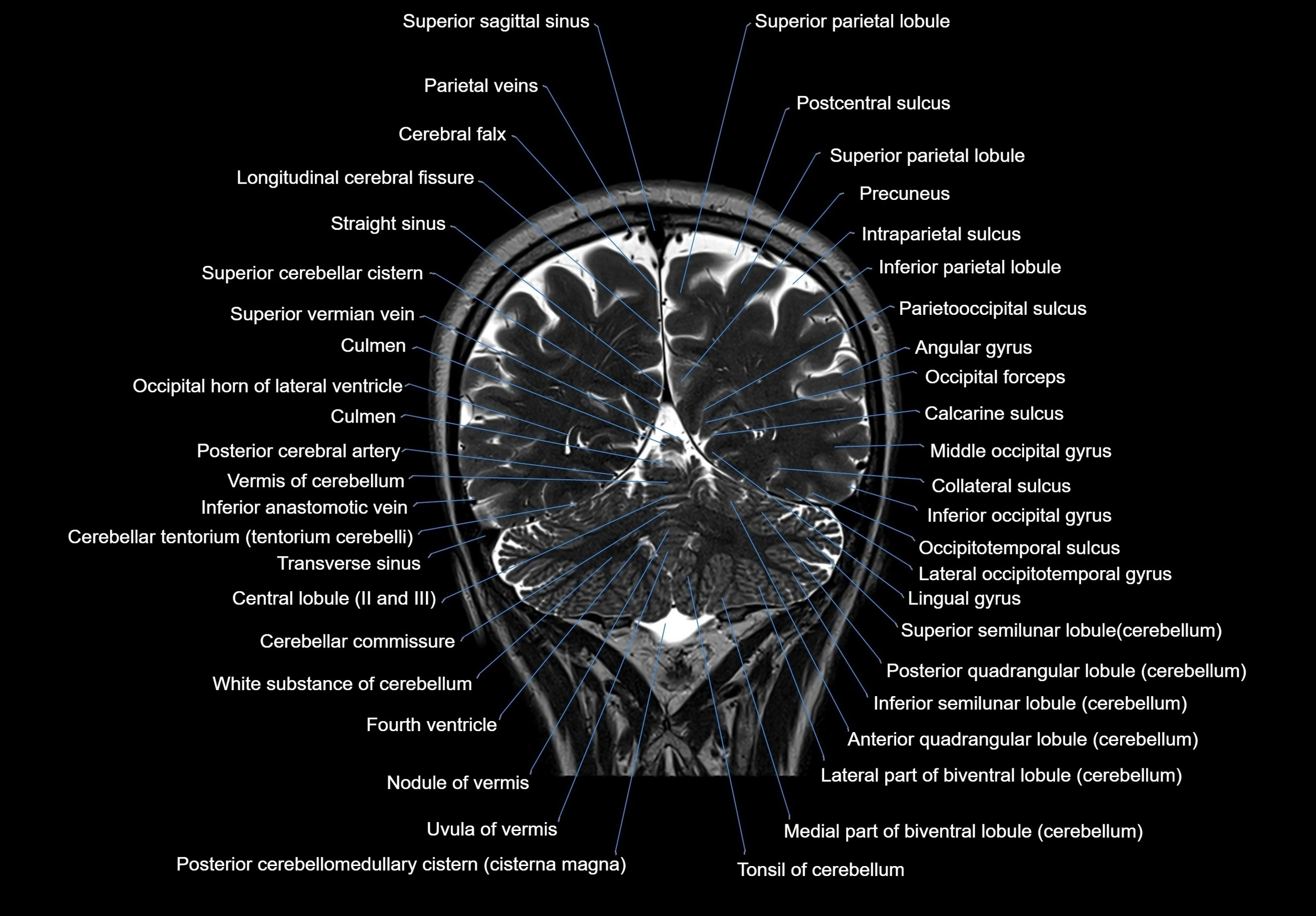 MRI Brain coronal cross sectional labelled anatomy 3T image  -img-00001-00055.webp